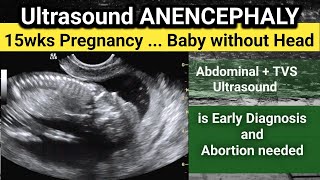 ANENCEPHALY  15 wks Pregnancy Ultrasound  why early Diagnosis is important [upl. by Mir]