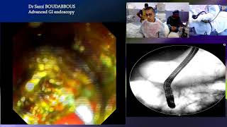 ERCP for acute cholangitis [upl. by Ylrac]