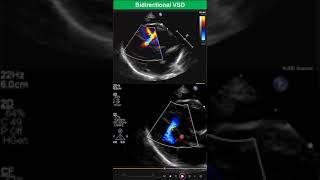 Bidirectional Ventricular Septal Defect Early Stage of Eisenmenger Syndrome [upl. by Erusaert959]