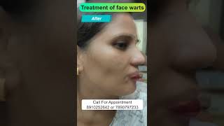 Treatment of face warts  By Dr Uttam Kumar Lenka MBBS MD Consultant Dermatologist [upl. by Derwon103]