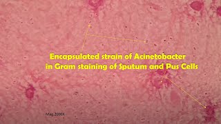 Acinetobacter in clinical sample Sputum Gram stain Microscopy at various magnifications [upl. by Eenat]