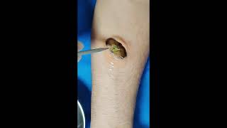 Botfly Maggot Removal spa doctor satisfying pimple [upl. by Sine109]