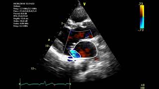 Echocardiographic assessment of the mitral valve [upl. by Maxine]