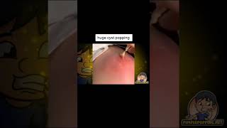 Cystic Acne Removal amp Inflammatory Acne [upl. by Cobbie244]