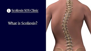 What is Scoliosis [upl. by Adnolehs1]