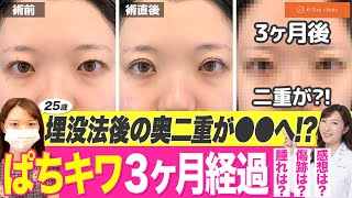 気になる術後の腫れや傷跡は？3ヶ月密着！【ぱちキワ＋埋没法】 [upl. by Leksehcey]