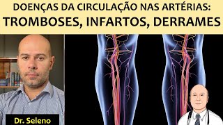 Doenças da circulação nas artérias aterosclerose infartos AVC e aneurismas [upl. by Saidnac47]