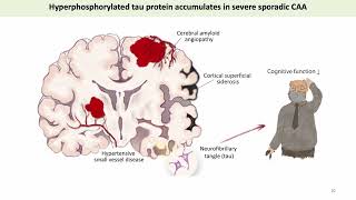 Cerebral Tau Pathology in Cerebral Amyloid Angiopathy [upl. by Anoet]