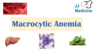 Macrocytic Anemia  Megaloblastic vs NonMegaloblastic  Approach amp Causes [upl. by Dorina591]