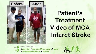 Patients Treatment video of MCA Infarct Stroke [upl. by Adok]