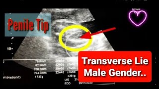 Male Gender l Transverse Lie l 🔥🔥🔥 [upl. by Enaid969]