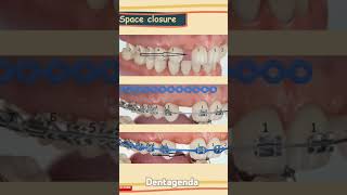 Orthodontic space closure in missing incisor traumatic injury [upl. by Arual]