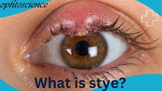 Stye How to get rid of stye fast stye or Chalazion [upl. by Warrenne546]