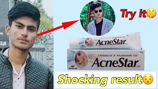 acnestar cream😍 acne star cream shorts youtubeshorts short [upl. by Iahs]