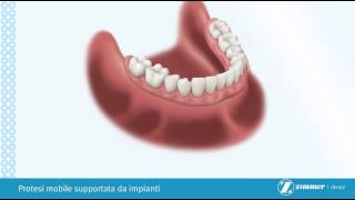 protesi mobile supportata da impianti dentali  a cura di CMO wwwcmosrlnet [upl. by Rhu]