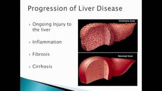 Alpha1 Antitrypsin Deficiency 101 Liver [upl. by Dwight657]