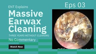 Satisfying Earwax Cleaning 3 Cholesteatoma No Commentary [upl. by Leiuqese]