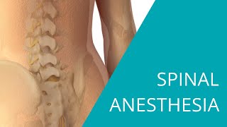 Spinal Anesthesia  The steps of spinal anesthesia [upl. by Nadoj]