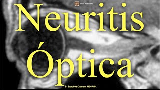 Neuritis Óptica [upl. by Rebme]