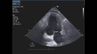 Free Wall Rupture and Pericardial Effusion [upl. by Joiner]