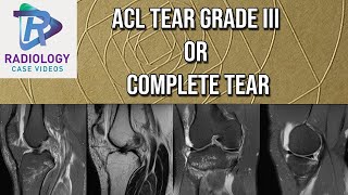 ACL Tear Grade III or Complete [upl. by Zullo]