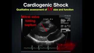 RUSH Rapid Ultrasound in Shock [upl. by Thanasi]