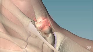 Mayo Clinic Minute Cause remedies for thumb arthritis [upl. by Atsocal]