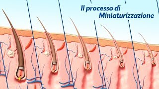 Alopecia Androgenetica il processo di Miniaturizzazione [upl. by Zelma]