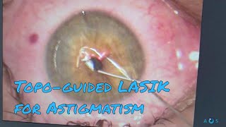 Contoura Vision Laser Eye Surgery for Astigmatism  Topographyguided LASIK PRK [upl. by Albert]