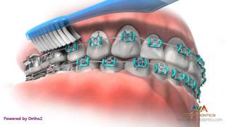 Life with Braces  Brushing amp Flossing [upl. by Llehcal]