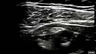 Ultrasoundguided Infraclavicular block  completed in 90sec [upl. by Yelehsa]