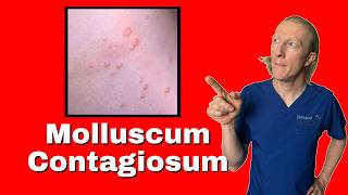 Molluscum Contagiosum causes diagnosis and treatments [upl. by Krock]