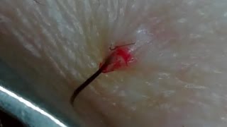 Ingrown Hair 埋没毛の救出！PART7 [upl. by Ycnuahc]