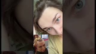 Forehead reduction with hair transplant hairlinelowering foreheadreduction hairtransplantresults [upl. by Enawyd]