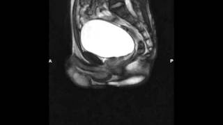 12 Shy Bladder  Paruresis Breath holding in an MRI [upl. by Droffats]