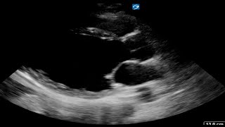 Dilated CMPMyocarditis [upl. by Michi]