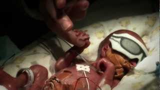 24 week premature baby  Tobys journey [upl. by Aisiram]