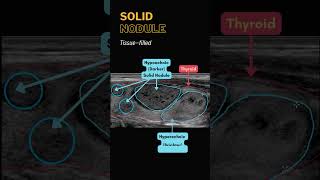 Thyroid Nodule Ultrasound  Cystic Solid Complicated Calcifications [upl. by Alvord]