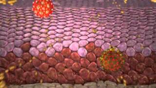 Cervical intraepithelial neoplasia [upl. by Assetniuq601]