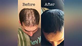 KIRKLAND SIGNATURE Minoxidil for Men 5 Minoxidil Hair Regrowth Treatment 12 Months review [upl. by Irelav511]