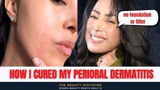 HOW I CURED MY PERIORAL DERMATITIS IN THREE 3 DAYS [upl. by Ycnaffit]