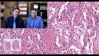 Pattern 4  Fibrosing Organizing Pneumonia [upl. by Ahselrak]