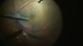 Fovea Sparing ILM Peeling for Vitreomacular Traction with Foveal Detachment [upl. by Flyn]