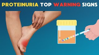 Top Warning Signs of Proteinuria Protect Your Kidneys [upl. by Luna881]