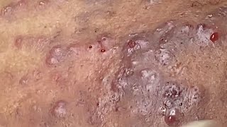 Extreme Acne Treatment [upl. by Lednahs]