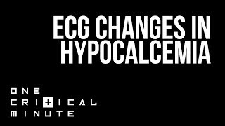 ECG changes in Hypocalcemia  One Critical Minute 1CM [upl. by Cecilla]