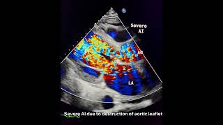 Infective Endocarditisto drahmadmirdamadisiy66XFU4h2QChqFiV [upl. by Daune]