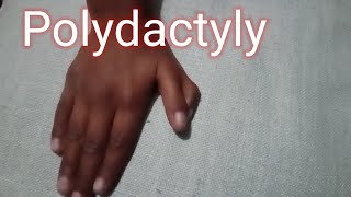 Polydactyly Double Thumb [upl. by Conal909]