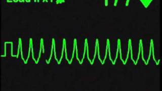 Monomorphic Ventricular Tachycardia  ECG Simulator  Arrhythmia Simulator [upl. by Imefulo]