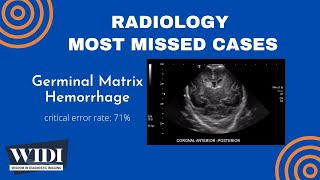 Most Missed Cases Germinal Matrix Hemorrhage [upl. by Eskil111]